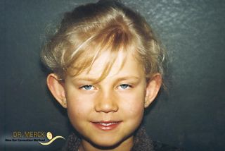 Abstehende Ohren vor OP - Bild 1